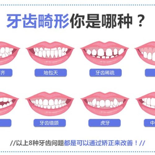 1000副隱形牙套免費送