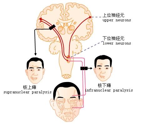 面瘫怎么治疗最有效