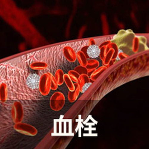 北京天健醫(yī)院特聘專家劉興志講血栓