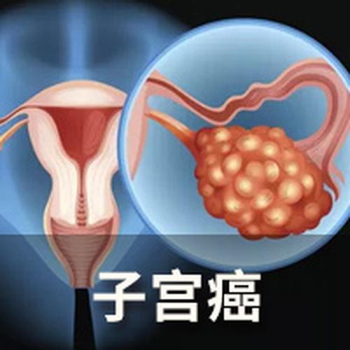 北京天健医院特聘专家杨中、陈淑艳讲子宫癌